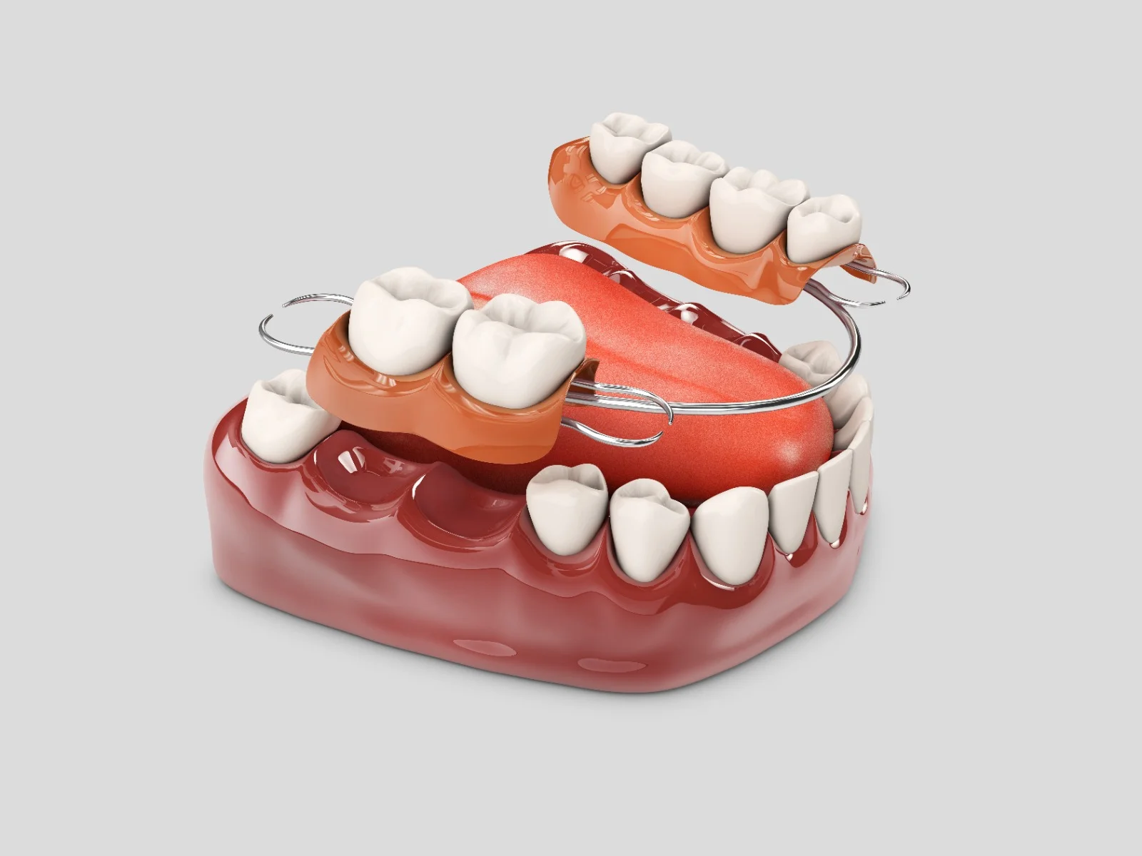 Partial dentures
