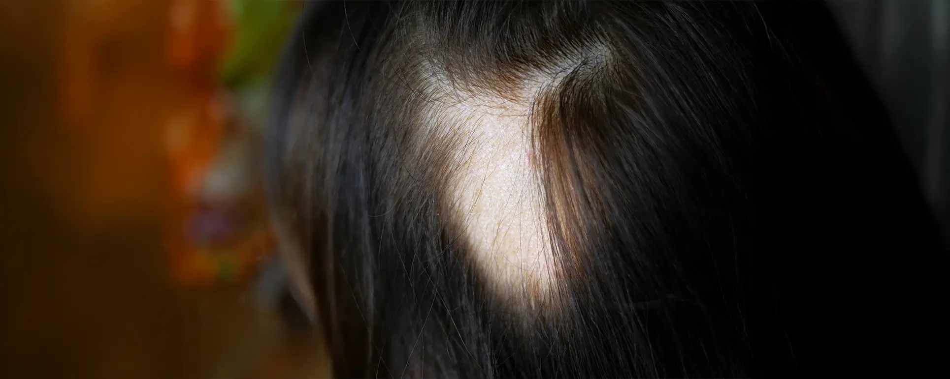 Patchy alopecia areata bald patches scalp