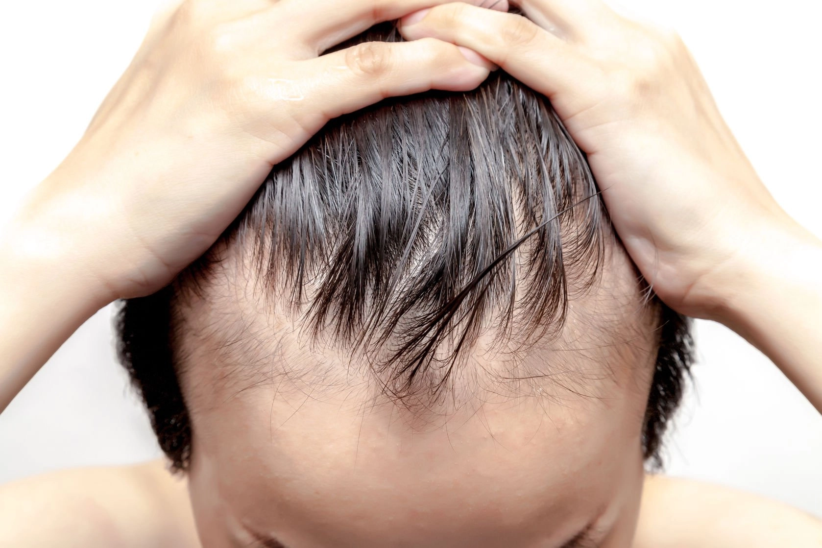 Pattern hair loss androgenetic alopecia