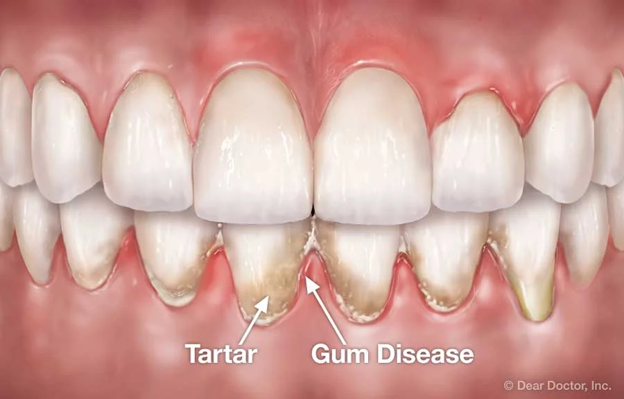 Periodontal Diseases & Flap