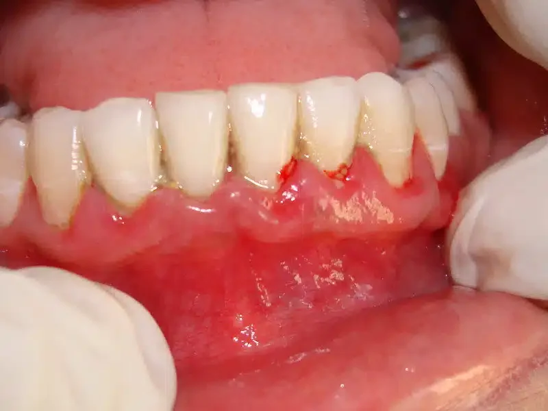 Periodontal flap surgery
