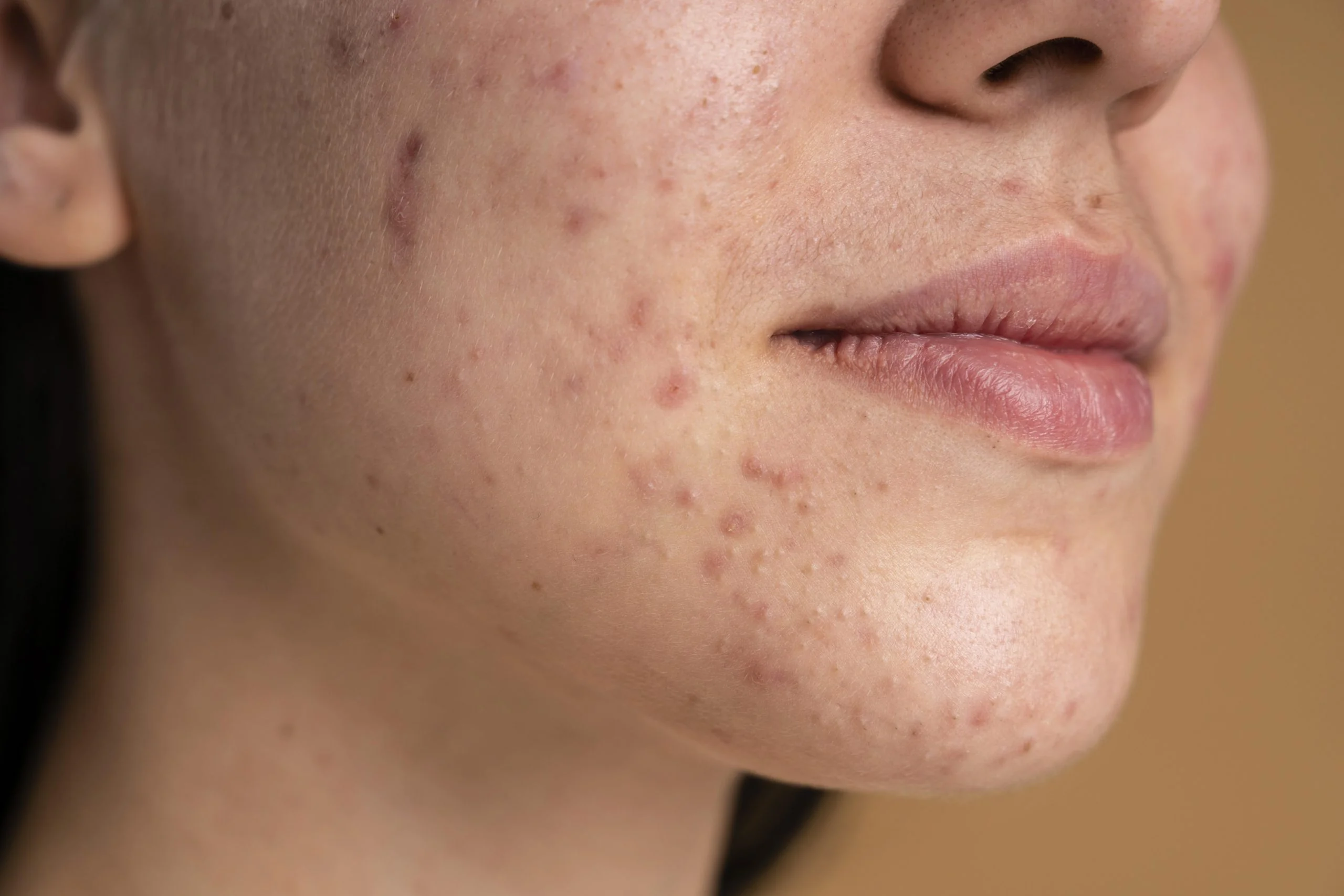Pigmentation at Aliva Aesthetics, Vijayawada