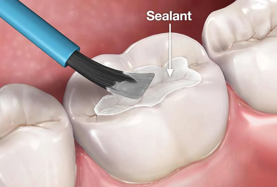Pit fissure cavity dental filling
