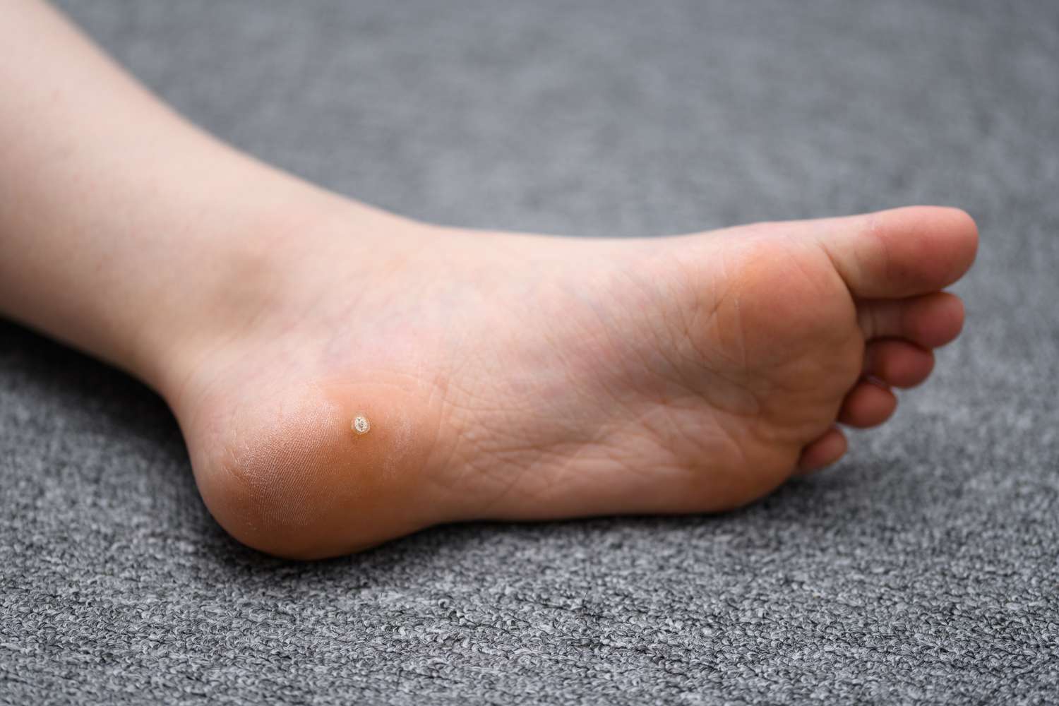 Plantar Warts — Skin Tags & Warts