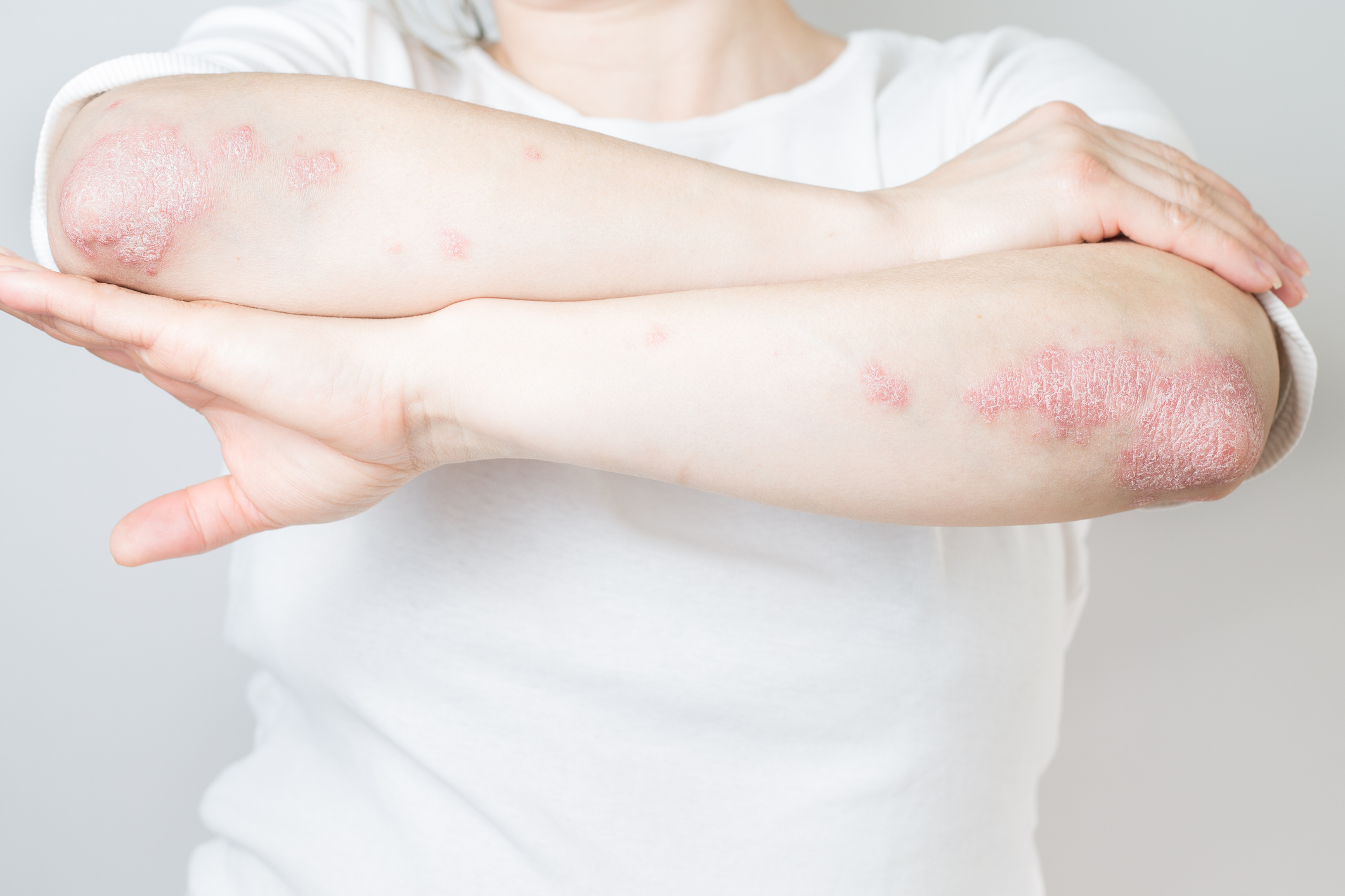 Plaque Psoriasis — Psoriasis