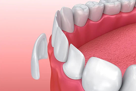 Porcelain veneers cosmetic dental result
