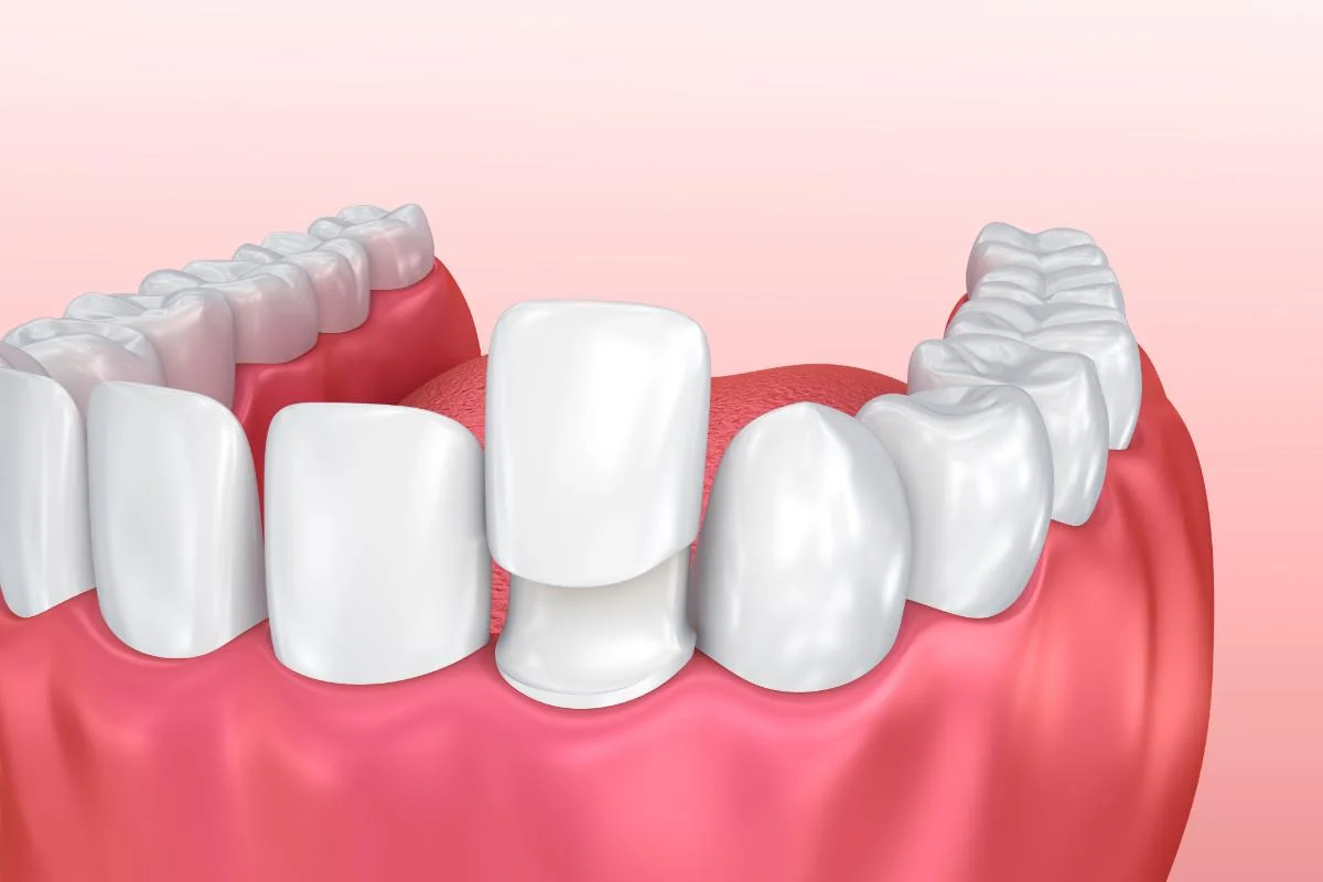 Porcelain veneers placement cosmetic