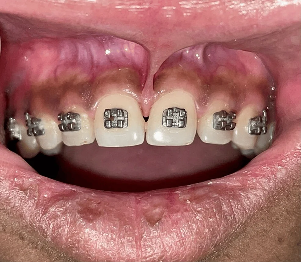 Post-orthodontic frenectomy