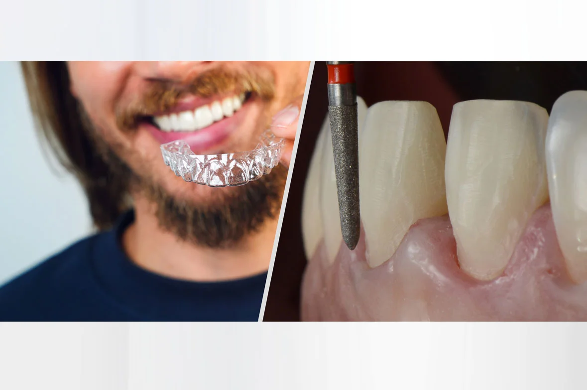 Pre-restorative aligners dental