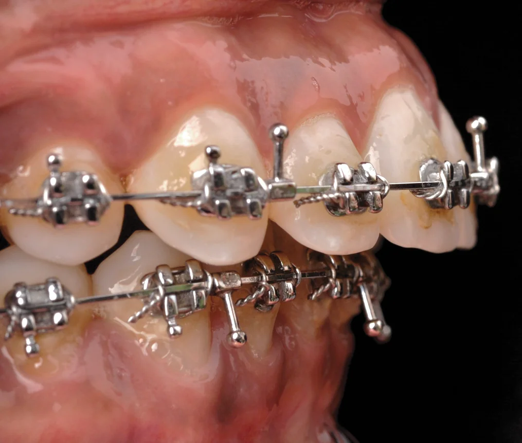 Pre-surgical orthodontics jaw