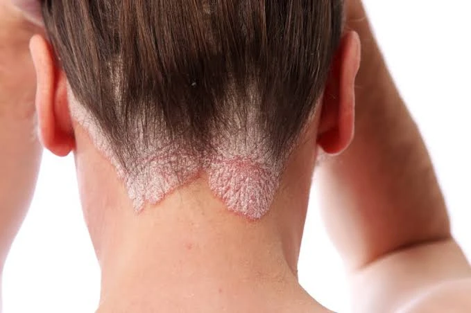 Psoriasis at Aliva Aesthetics Vijayawada