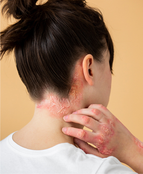 Before psoriasis treatment