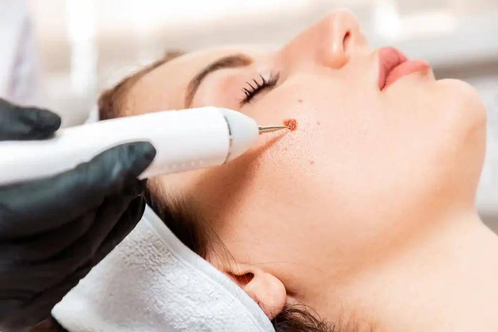 Radiofrequency Removal — Skin Tags & Warts at Aliva Aesthetics