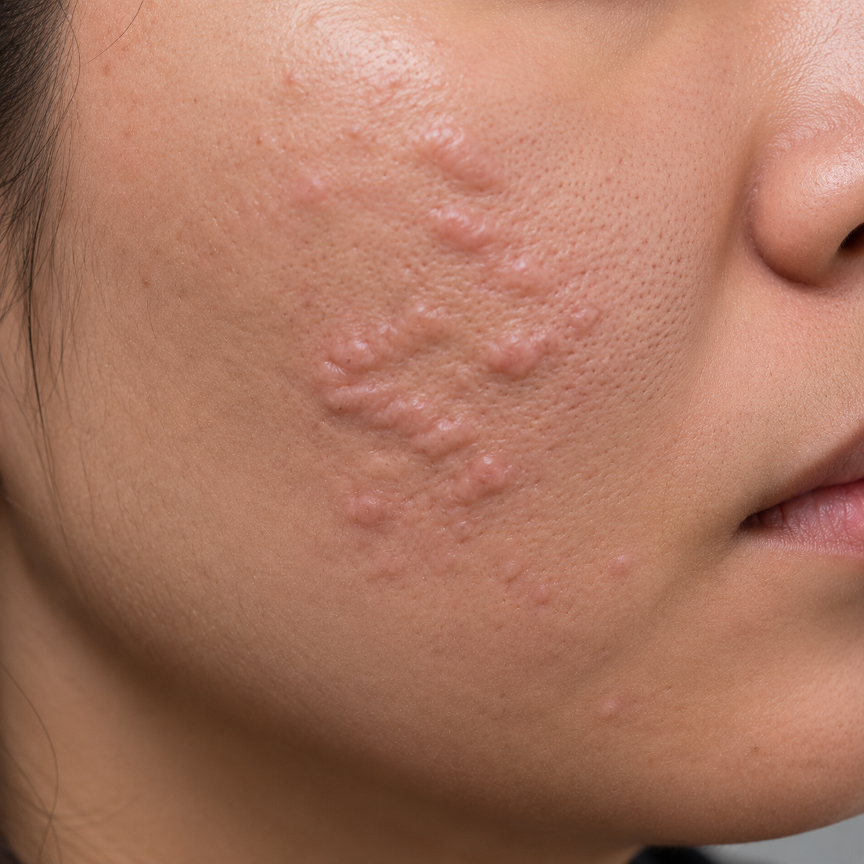 Raised hypertrophic scar tissue