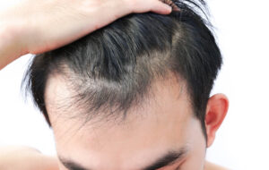 Early receding hairline regrowth therapy