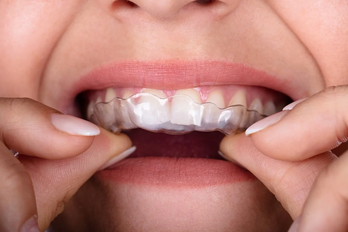 Refinement aligners orthodontic