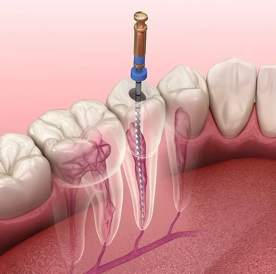 Root canal treatment cavity
