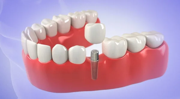 Same-day dental implant