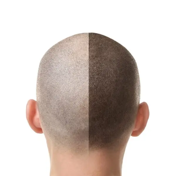 Scalp micropigmentation SMP treatment