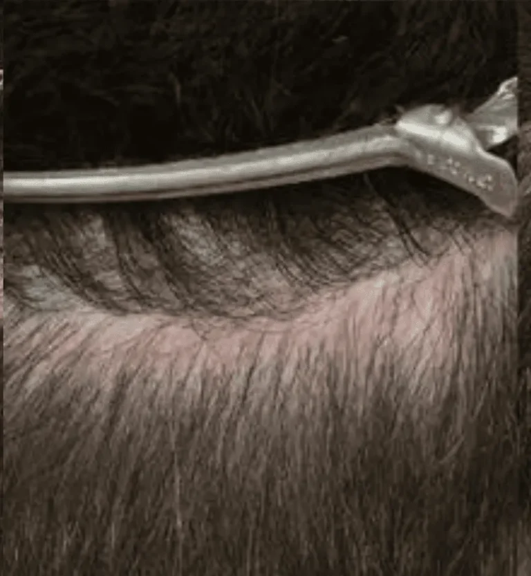 Scar repair grafting hair restoration