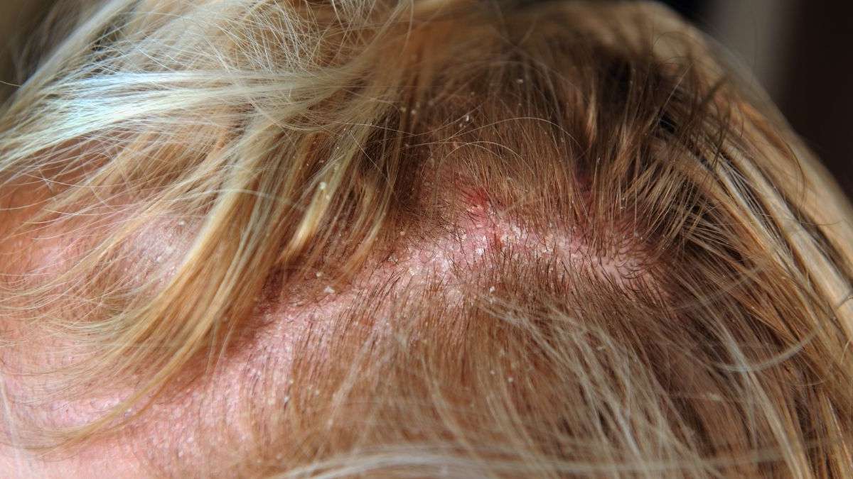 Seborrheic dermatitis oily scalp