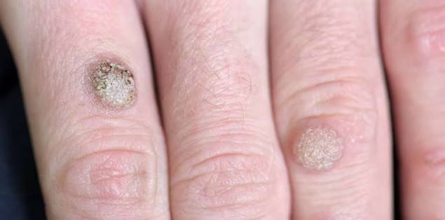 Seborrhoeic Keratoses — Skin Tags & Warts