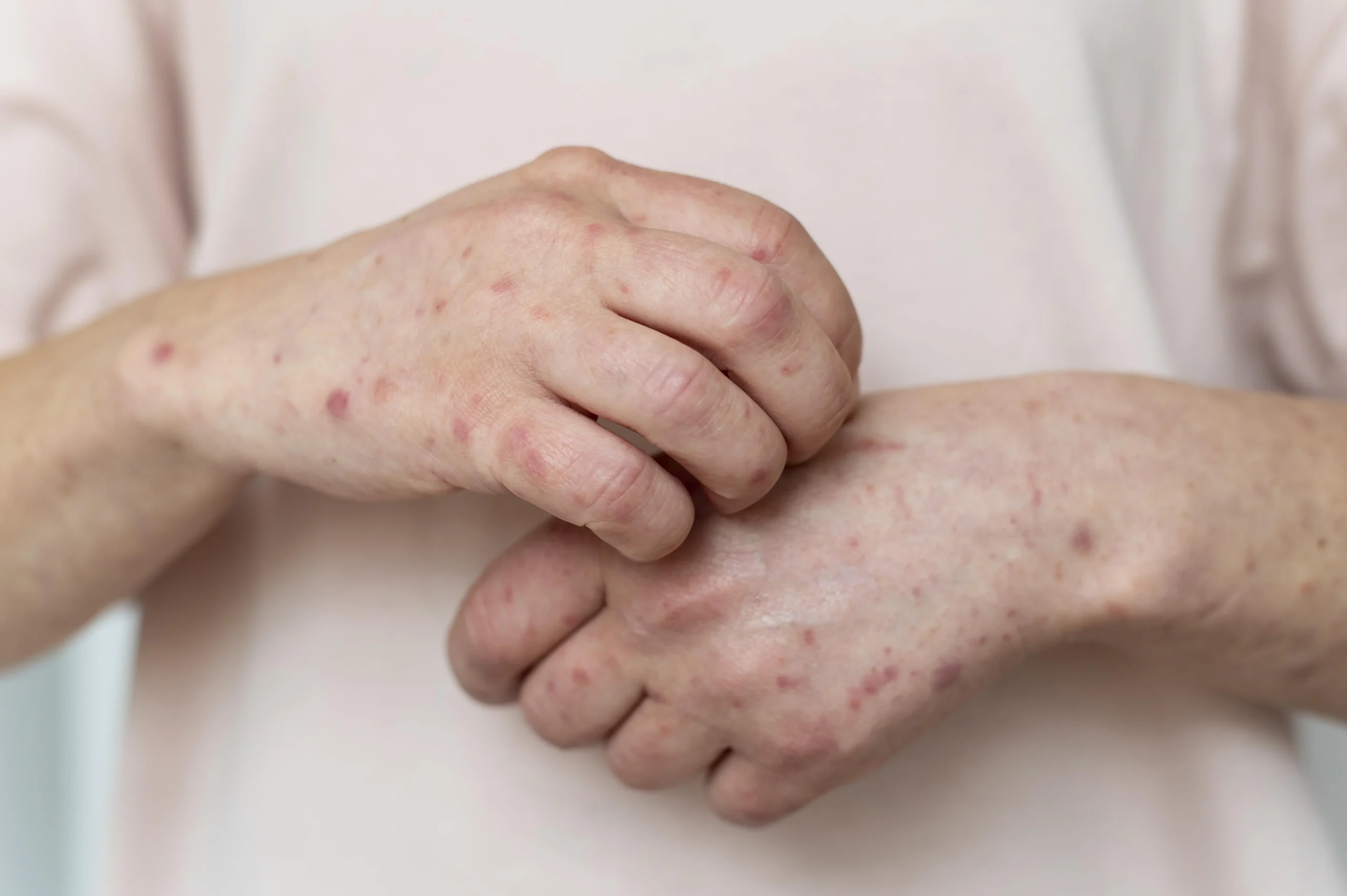 Skin Allergies and Rashes