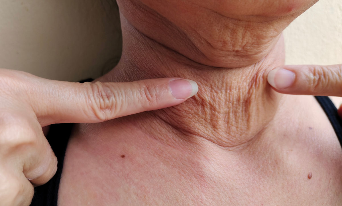 Facial volume loss with age