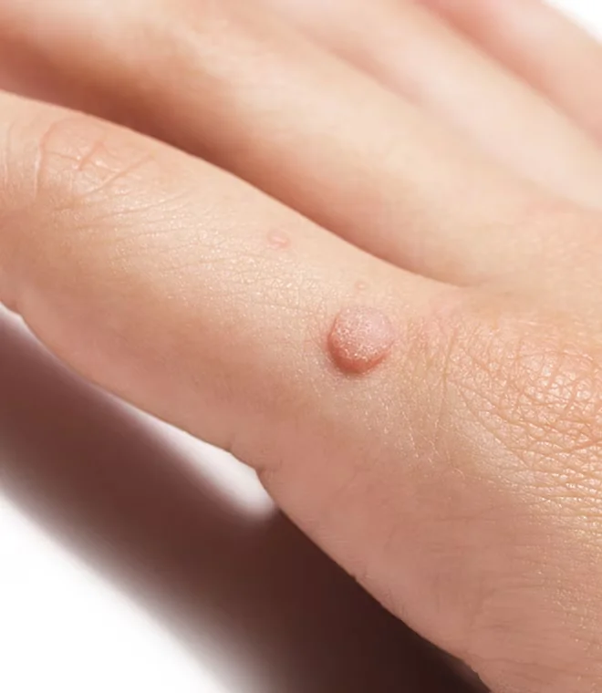 Skin Tags & Warts consultation at Aliva Aesthetics