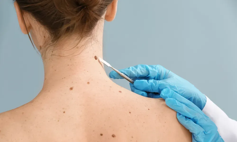 Skin Tags & Warts at Aliva Aesthetics Vijayawada