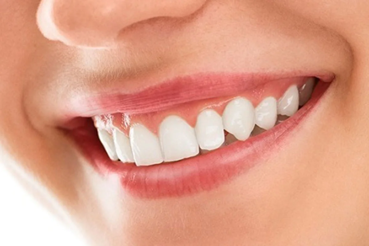 Smile makeover cosmetic consultation