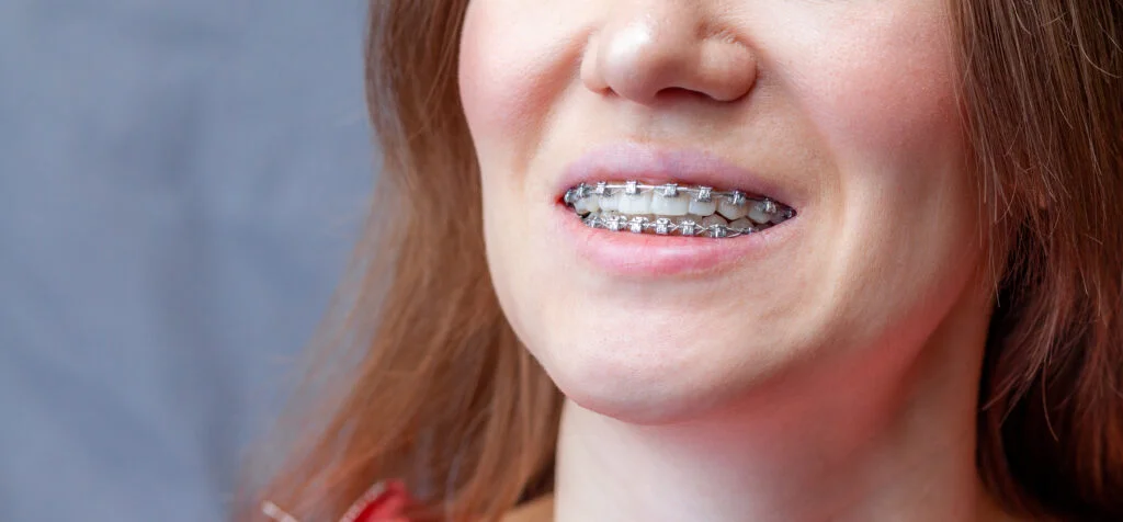 Overbite correction braces dental