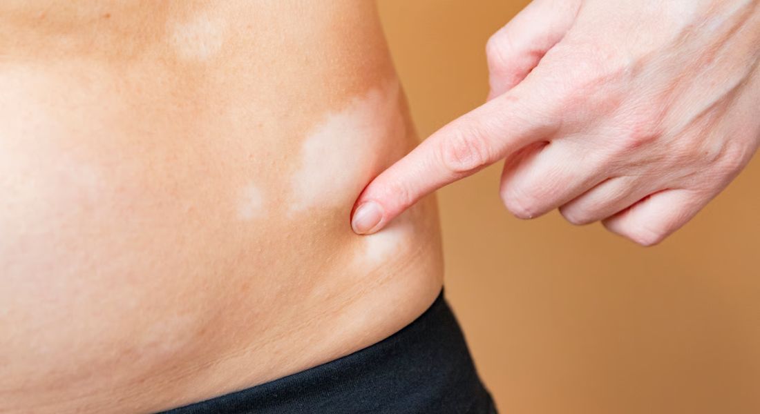 Stable Vitiligo — Vitiligo