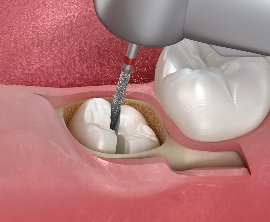 Surgical wisdom tooth extraction