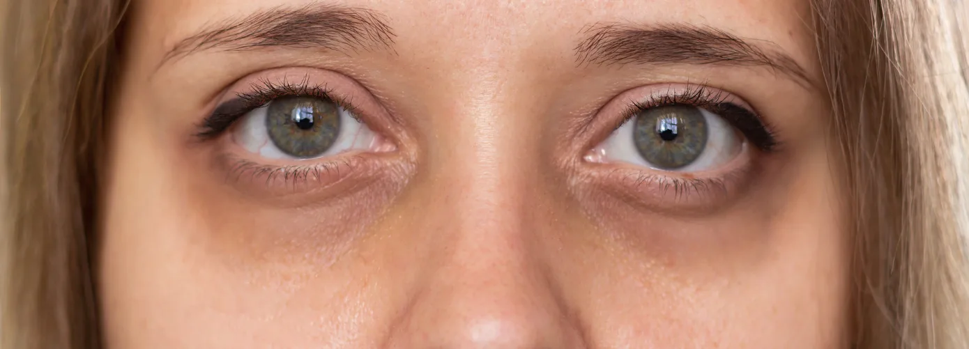 Volume loss and tear trough hollow