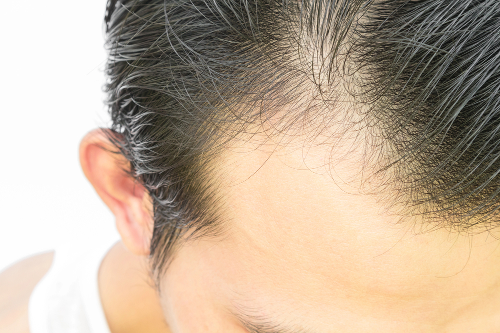 Telogen effluvium diffuse hair shedding
