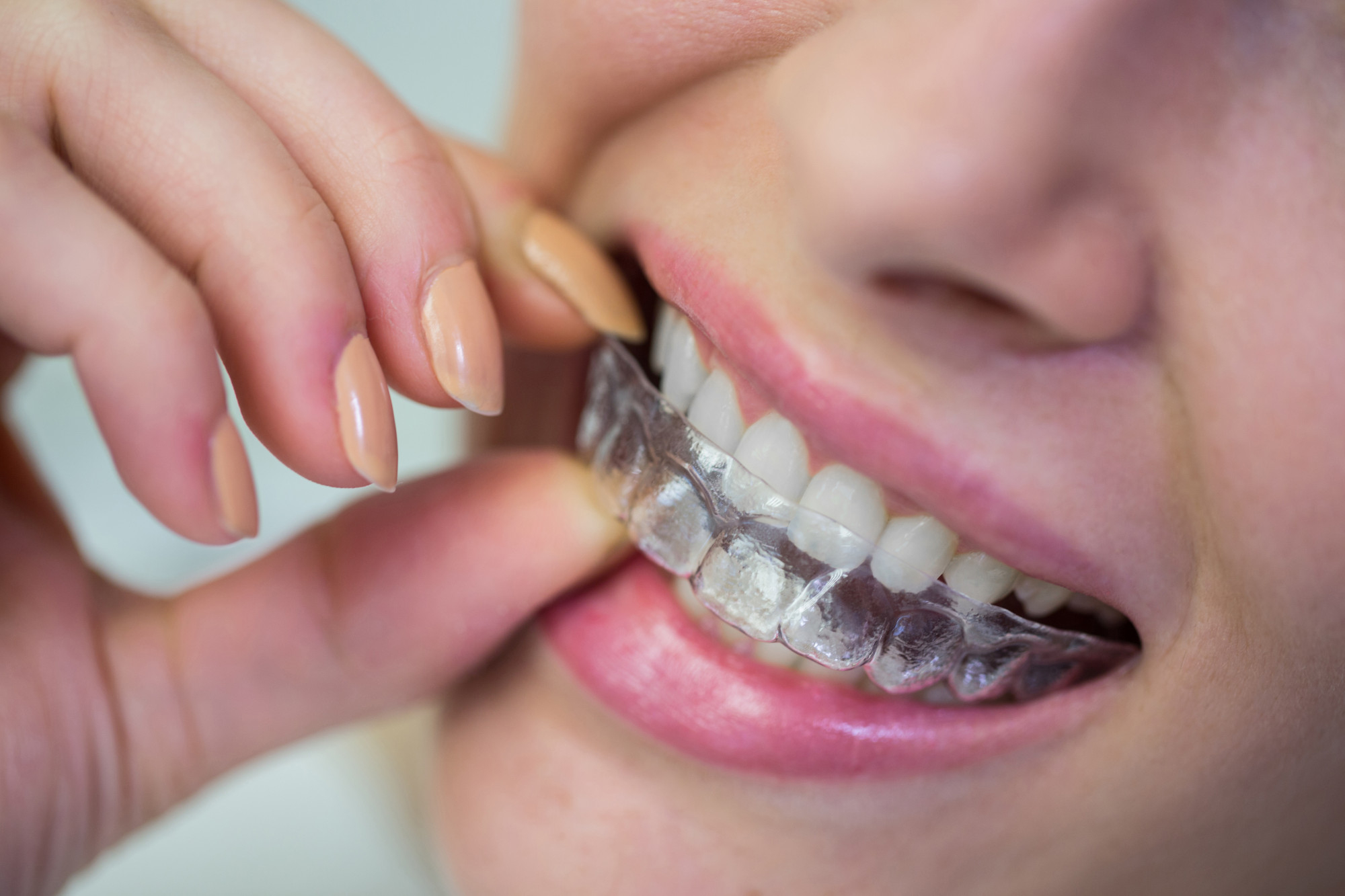 Tooth Aligners