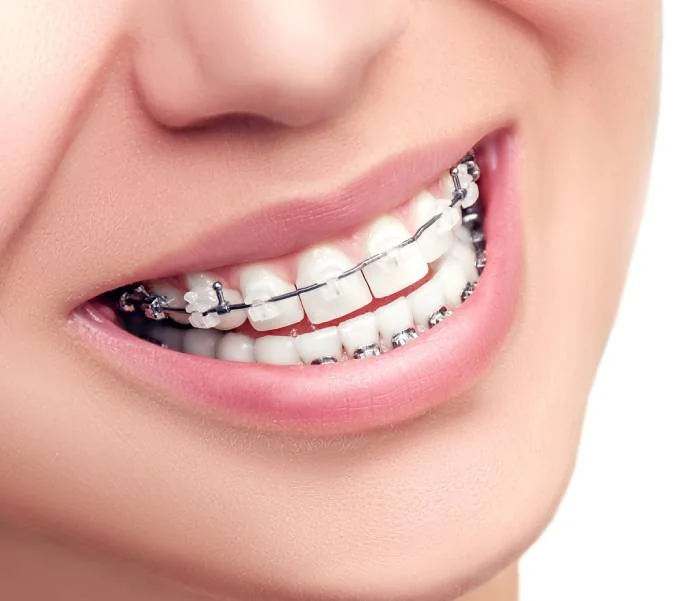 Tooth Braces