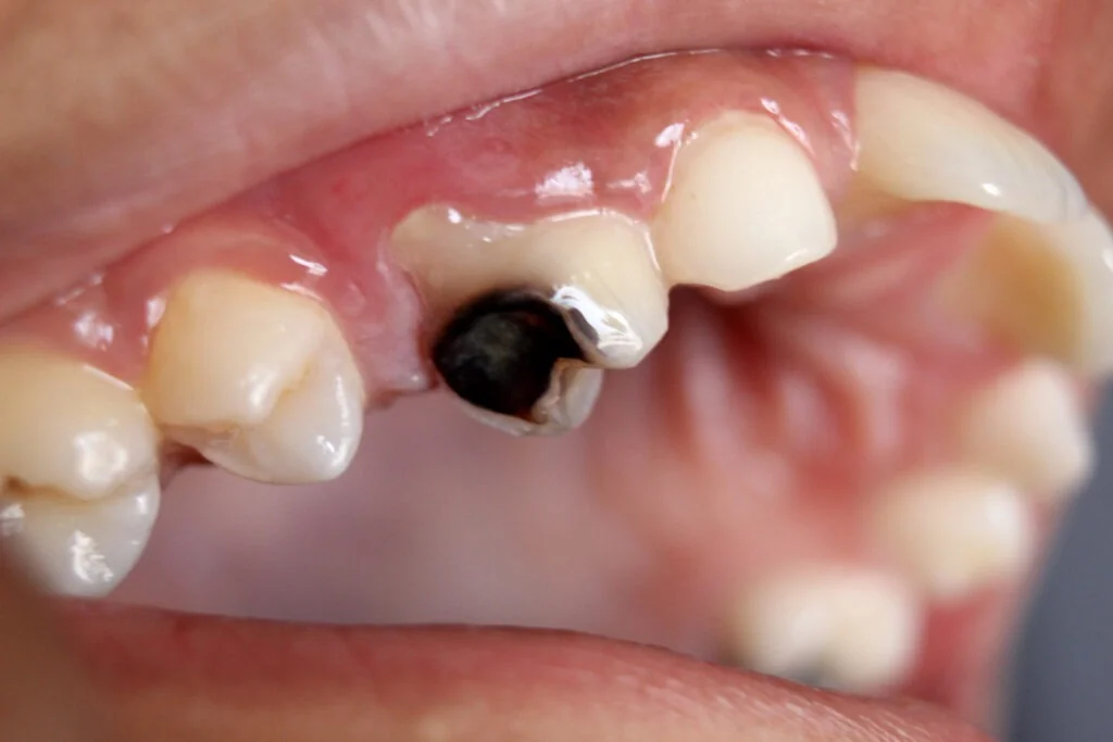 Tooth Decay & Dental Cavities