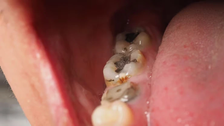 Understanding Tooth Decay & Dental Cavities