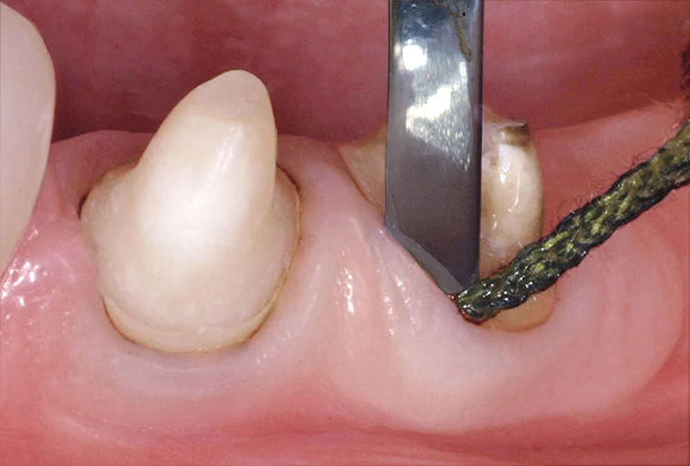 Tooth preparation impression dental