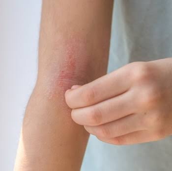 Topical Immunomodulators — Vitiligo at Aliva Aesthetics