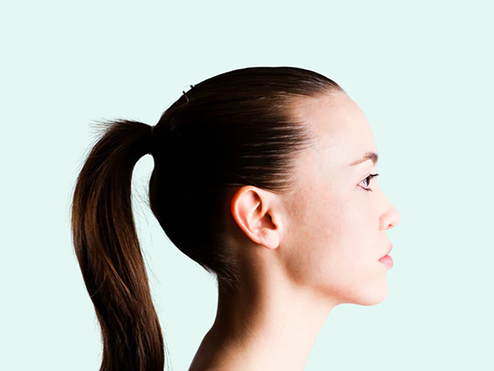 Traction alopecia tight hairstyle damage
