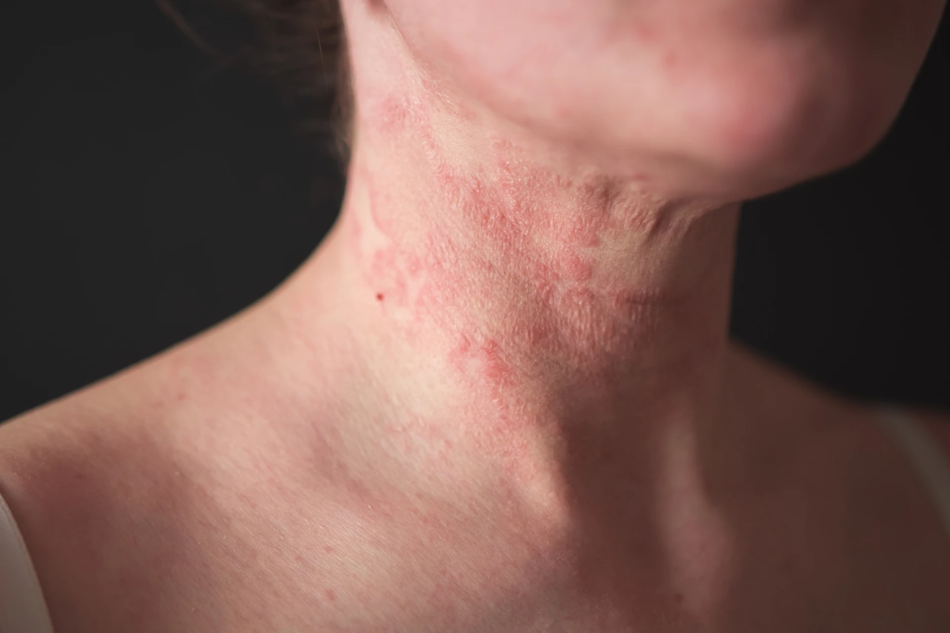 Trigger Identification Programme — Eczema at Aliva Aesthetics