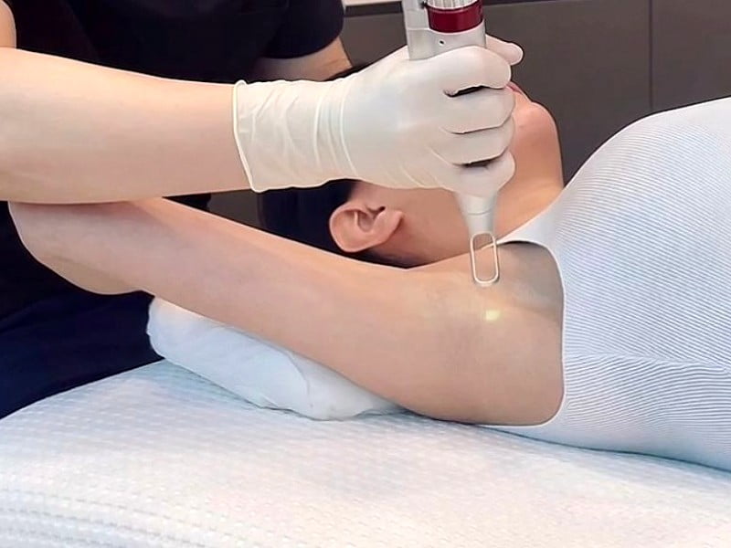 Laser hair removal underarm treatment