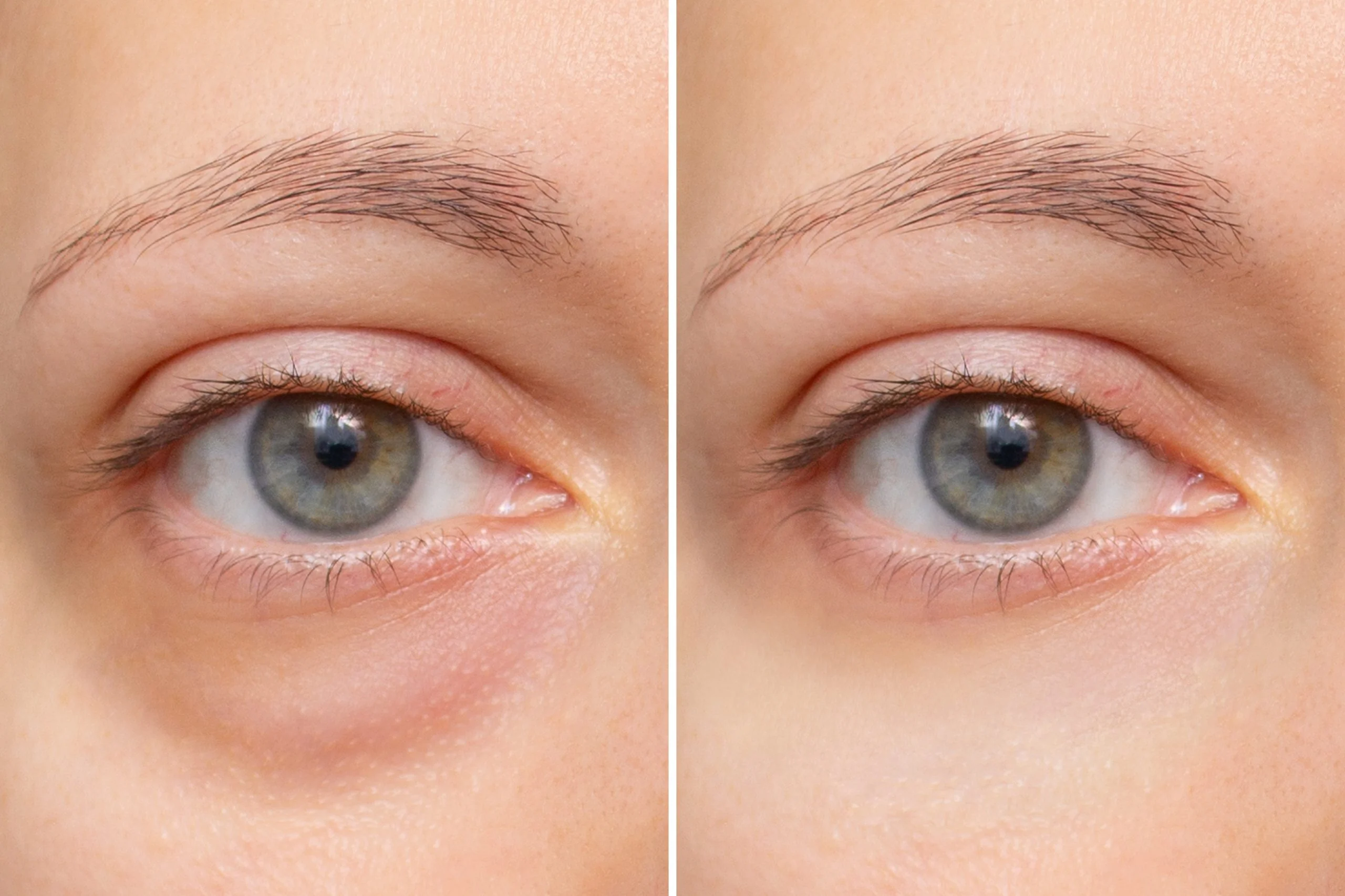 Under Eye Treatment at Aliva Aesthetics, Vijayawada