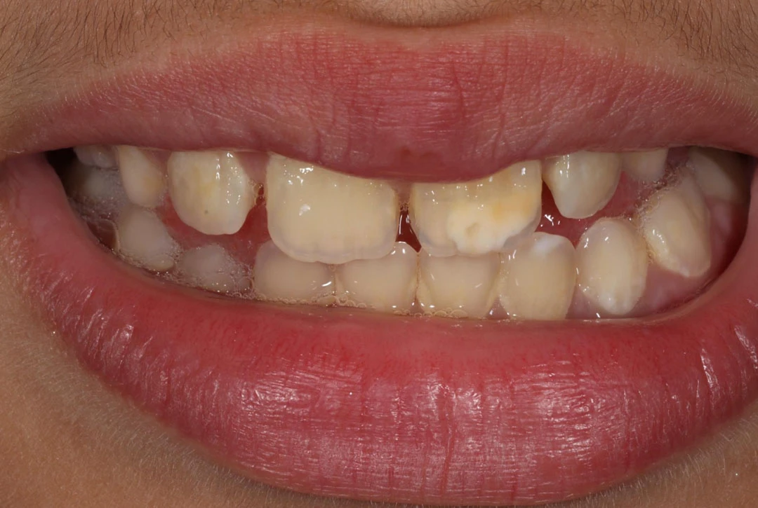 White spot lesion fluoride dental