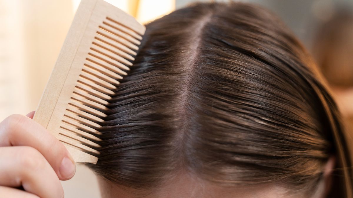 Widening part female androgenic alopecia