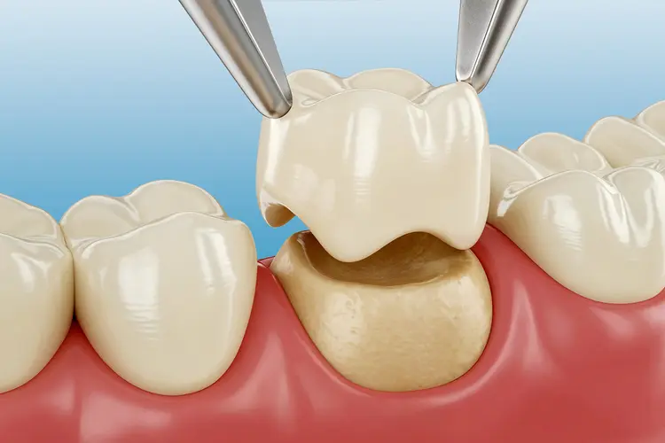 Zirconia crown molar restoration