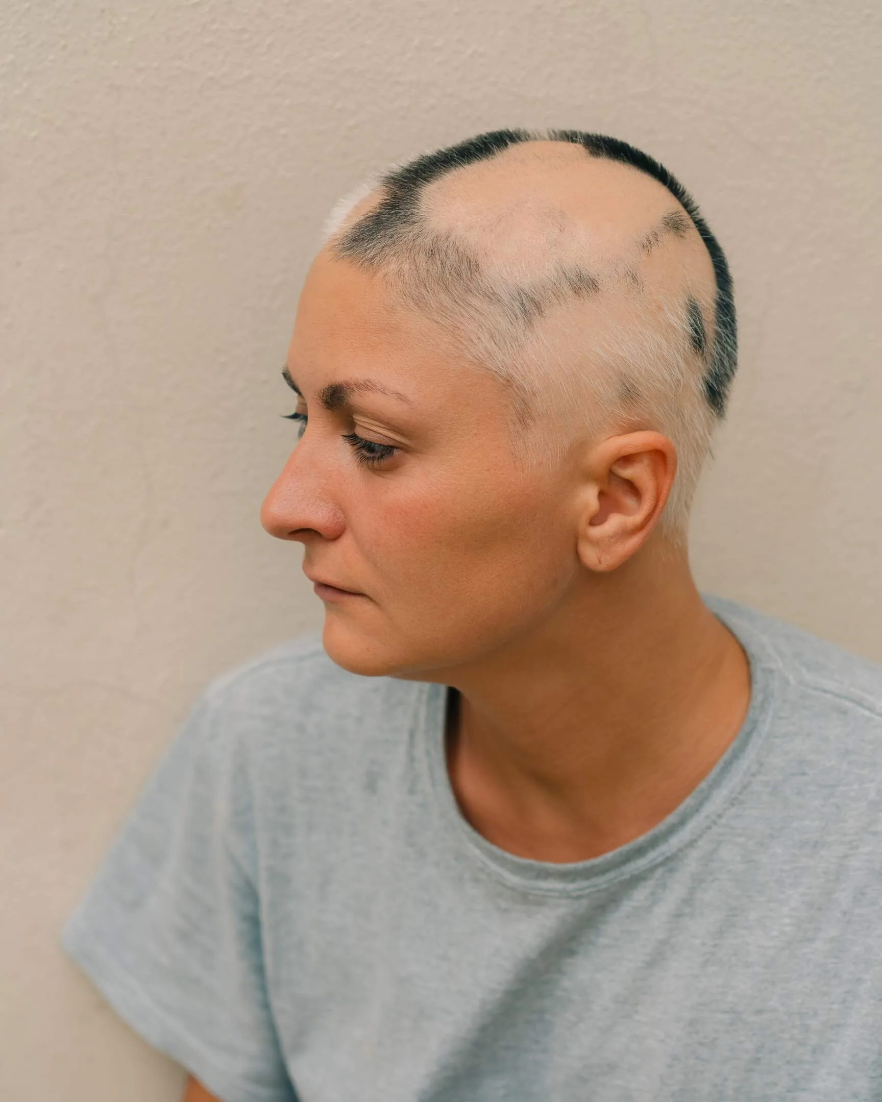 Alopecia Areata at Aliva Aesthetics, Vijayawada